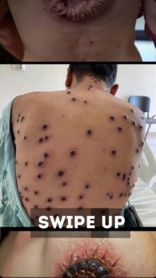 A Visual Guide to Viral Rashes — STORIES