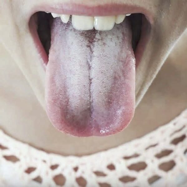 If Your Tongue Is White This Is A Clear Sign That You Are Suffering If Your Tongue Is White This Is A Clear Sign That You Are Suffering